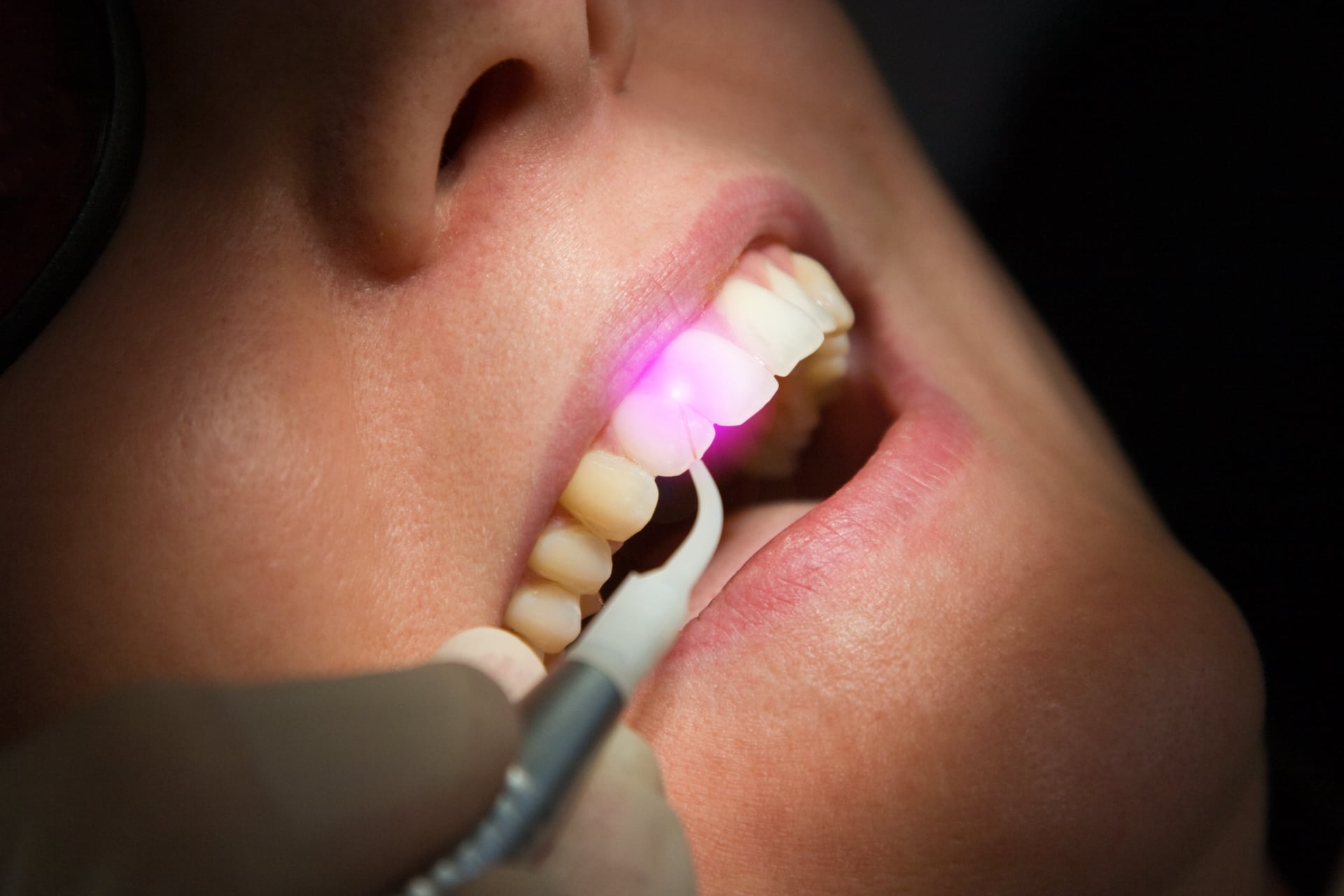 Laser in odontoiatria