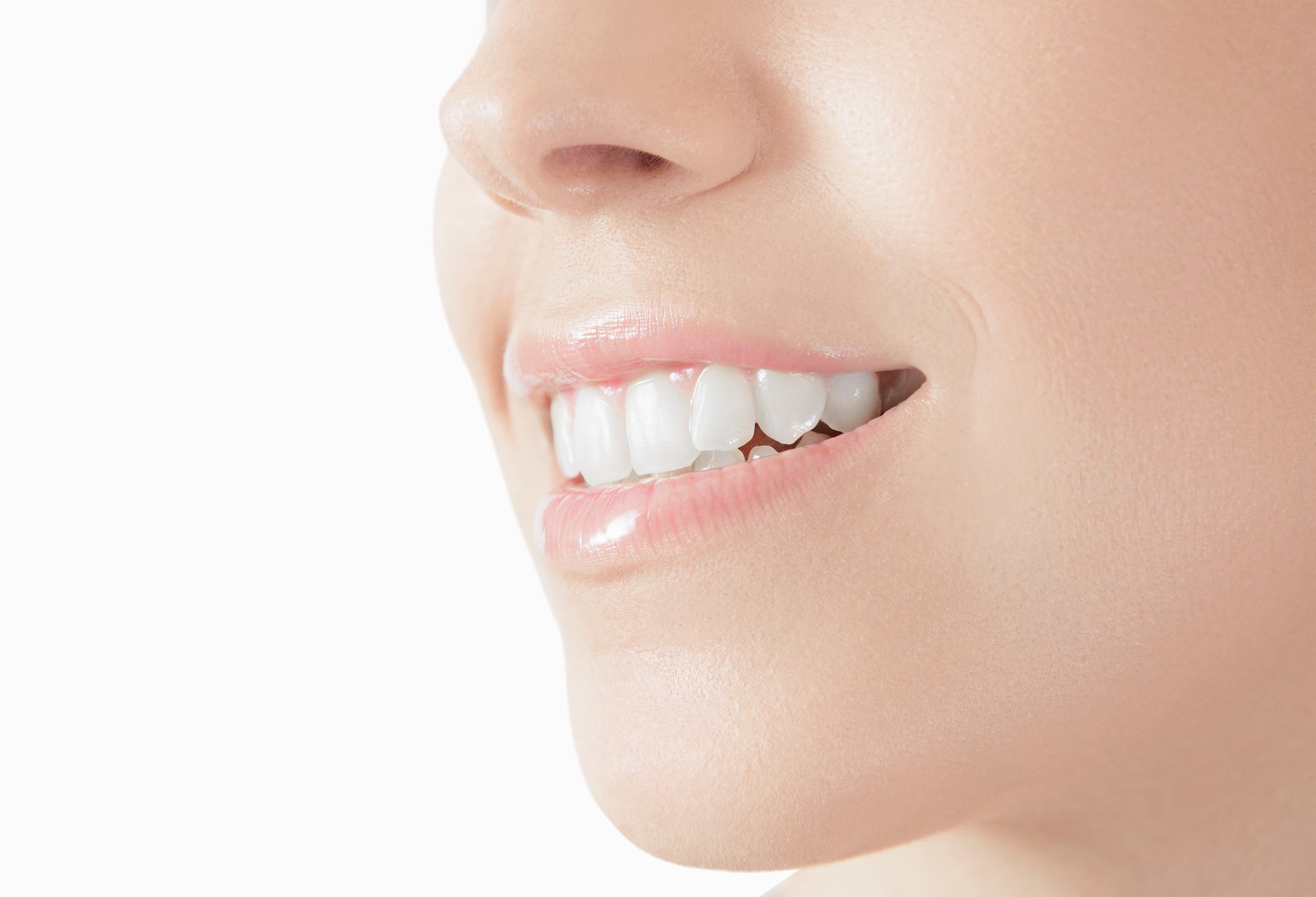 denti dopo trattamento di sbiancamento
