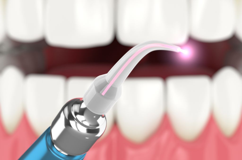 laser per curare i denti